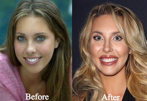 chloe lattanzi before plastic surgery